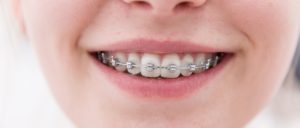 We offer complimentary orthodontic consultations. Schedule one for your child today!